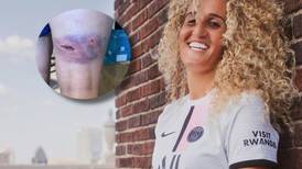 Jugadora del PSG muestra sus heridas tras sufrir brutal ataque