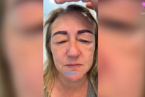 Mujer comparte grave reacción alérgica tras realizarse microblading de cejas