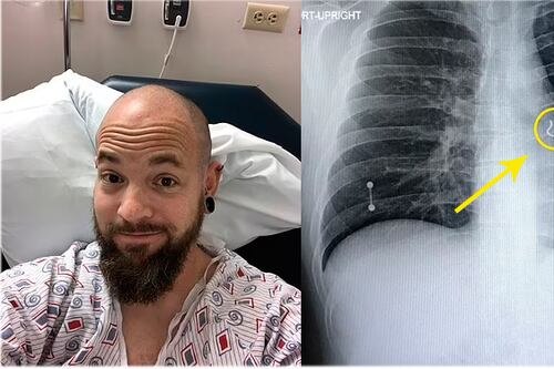 ¿Usted tiene piercing nasal?, el de este hombre terminó en su pulmón