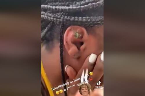 Le sacan a una turista un pequeño cangrejo de su oído en Puerto Rico